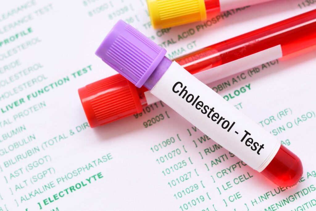 Ako funguje dobrý a zlý cholesterol a aké hodnoty by sme mali mať?