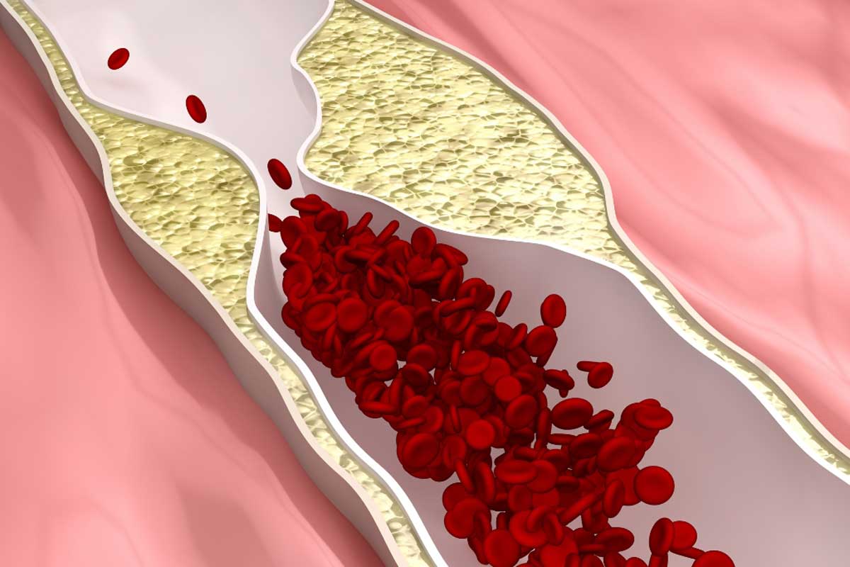 Máte vysokú hladinu cholesterolu? V žiadnom prípade to nerobte večer.